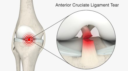 Anterior-Cruciate-Ligament-Tear